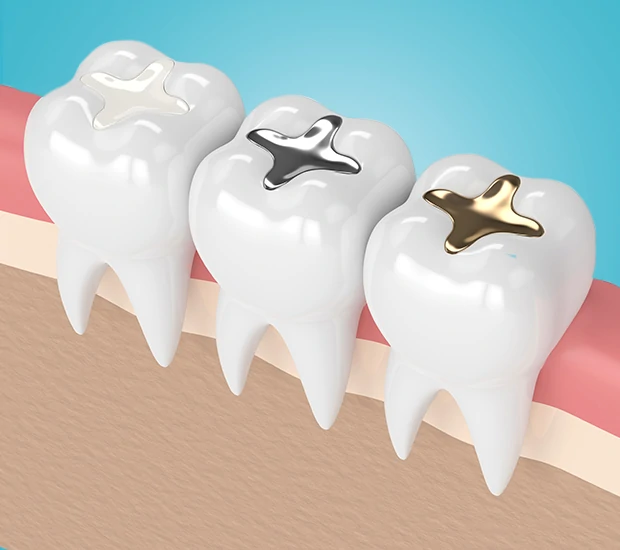 composite-fillings